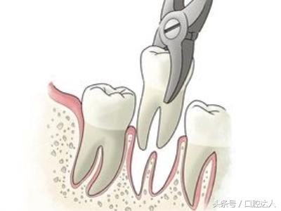 拔牙以后不要咽口水,拔牙后注意事项可以刷牙不
