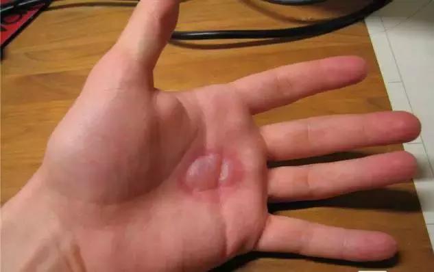 在家身上被开水烫伤后怎么急救,儿童开水烫伤急救处理