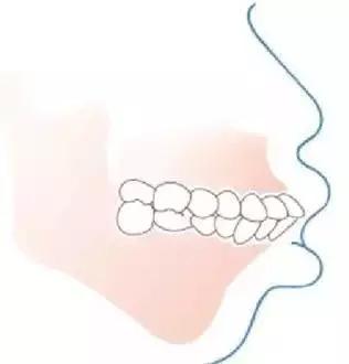儿童换牙长歪了怎么及时矫正,孩子换牙期怎样注意可以换整齐