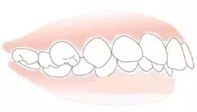 孩子刚刚换牙长歪了怎么补救,孩子换牙怎么才能确保不长歪