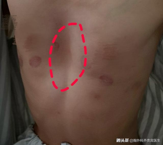 漏斗胸男怎么自己矫正,成年人漏斗胸保守治疗方法