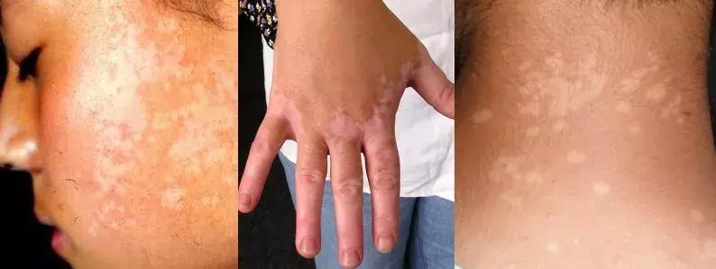 儿童脸上长白斑缺什么微量元素,宝宝脸上长白斑是怎么回事