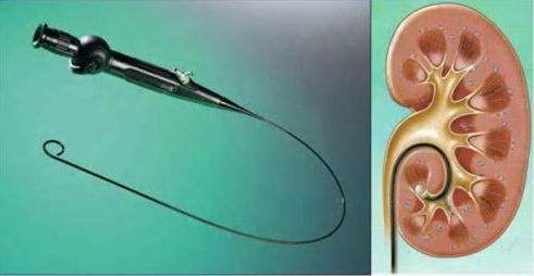 输尿管结石10x5mm要做手术吗,输尿管结石保守治疗方法有哪些