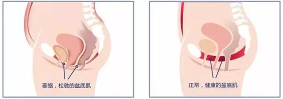 新妈注意!便秘、漏尿、XXOO不谐……产后这些尴尬都是因为它