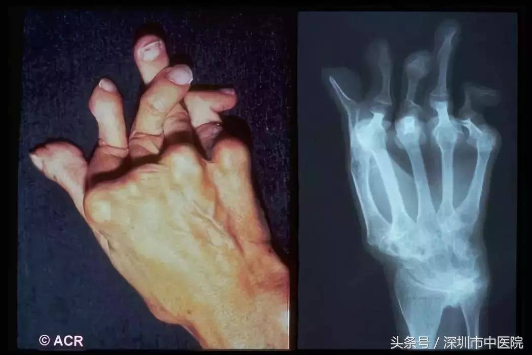 治疗类风湿最好的办法是什么,还在为颈肩腰腿不舒服发愁吗