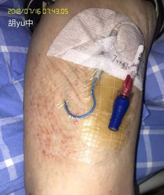 picc皮疹处理,picc湿疹的护理措施