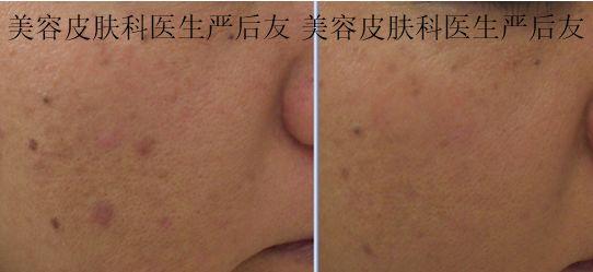 治疗毛孔粗大的护肤品,烟酰胺可以治疗毛孔粗大吗