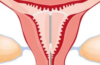 关于产后要不要上节育环,这些方面你要知道