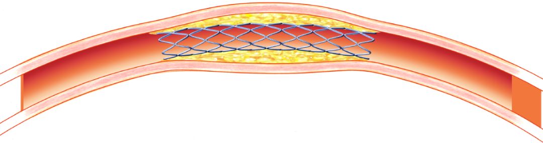 糖尿病下肢血管介入手术成功率,糖尿病下肢麻木中医辨证分析