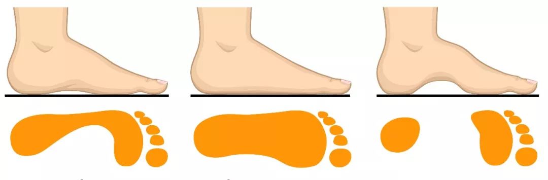 儿童扁平足矫正,儿童轻微扁平足还需要穿矫正鞋吗