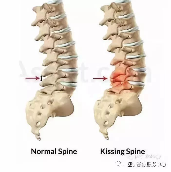 腰痛患者常用的特殊检查方法,腰痛影像诊断