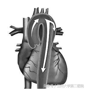 最新急性主动脉夹层诊断治疗指南,全力救治主动脉夹层