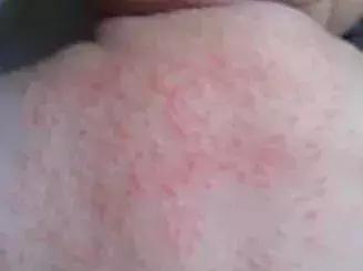 宝宝长小疹子后溃烂,宝宝的红疹子溃烂了