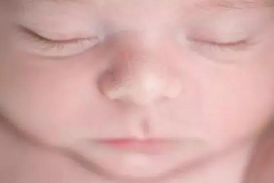 宝宝长小疹子后溃烂,宝宝的红疹子溃烂了