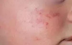 宝宝身上一大片的包是怎么回事,宝宝身上好多片包