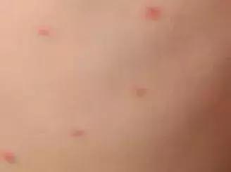 宝宝长小疹子后溃烂,宝宝的红疹子溃烂了