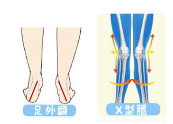 如何矫正足外翻和o型腿,走路足内翻怎么矫正