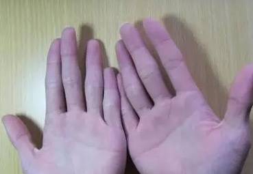 健康的手掌是什么颜色,看手掌鱼际颜色知健康