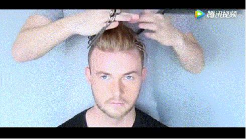 脱发比较严重的90后,脱发严重发际线越来越高