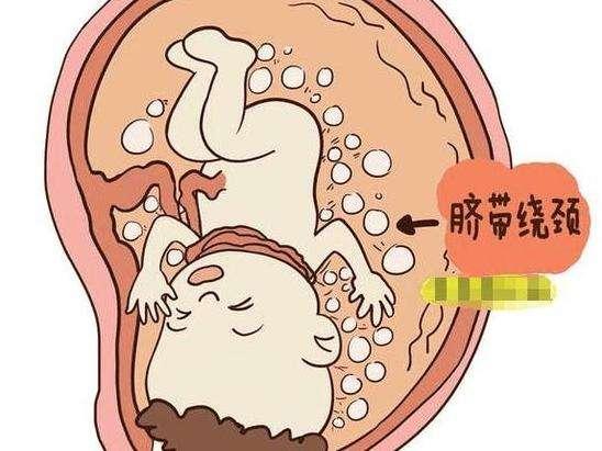 宝宝脐带绕颈怎么给宝宝说,宝宝脐带绕颈一圈该怎么办
