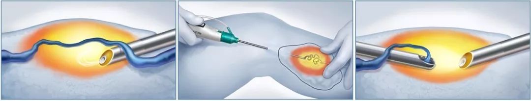 跷二郎腿有什么危害腿粗,跷二郎腿有什么危害图片