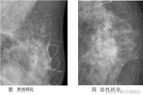 乳腺彩超有钙化好还是没钙化好,乳腺增生钙化吃啥药好