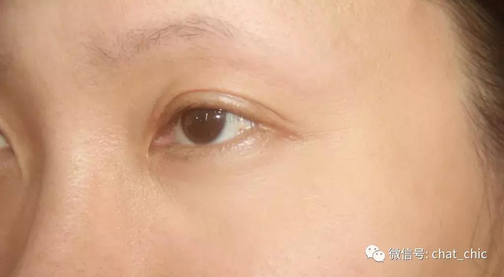 出现第一条鱼尾纹该怎么预防,鱼尾纹是怎么来的