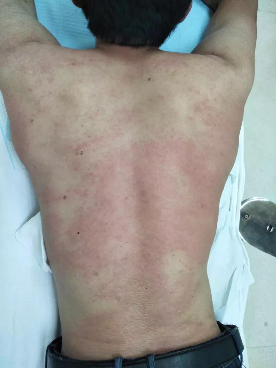 被蜜蜂蛰死亡新闻,蜜蜂蜇人会致人死亡吗