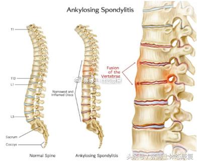 强直性脊柱炎有没有可能完全康复,强直性脊柱炎髋关节粘连康复训练