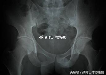 强直性脊柱炎有没有可能完全康复,强直性脊柱炎髋关节粘连康复训练