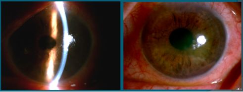 角膜上皮细胞损伤多久能恢复,治疗角膜上皮细胞损伤全国专家