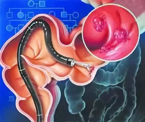 痔疮会引起直肠癌吗,直肠癌与痔疮的鉴别