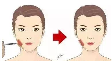 整形医生揭露行业黑幕,注射玻尿酸的八大谣言别再相信了