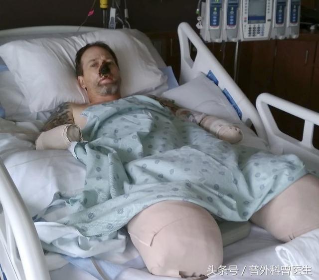 宠物狗舔到快愈合的伤口有事吗,被狗狗舔了一下就截肢了