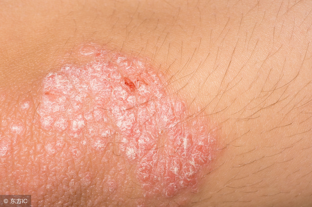 得了脂溢性皮炎怎么治,脂溢性皮炎到底要怎么治