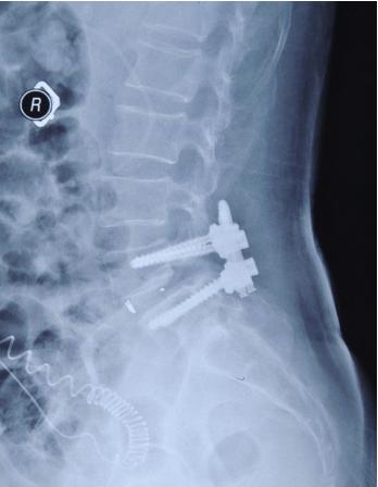 脊柱手术打入4个钉子多久能活动,脊柱手术打19个钢钉