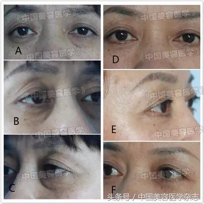 外眦韧带固定是什么手术,外眦悬吊固定疤痕多久恢复