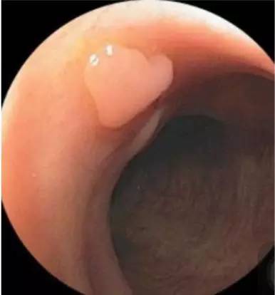 当内镜遇到情人节……