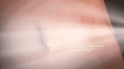 伤口愈合擦什么药膏不会留疤,伤口怎么正确处理不留疤