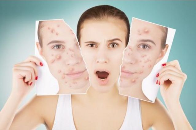 青春痘伤疤怎么修复,青春痘时间长疤痕修复的最佳方法