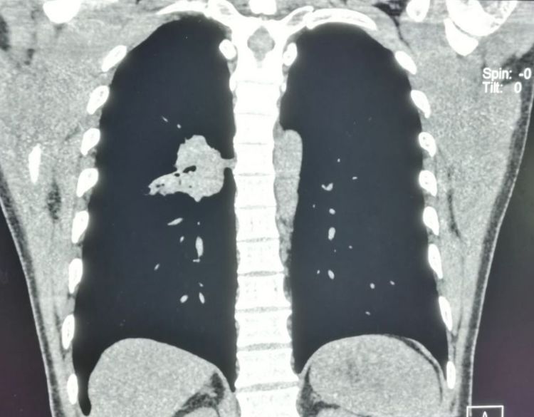 年轻人切除一个肾脏,切除一个肾脏手术全过程