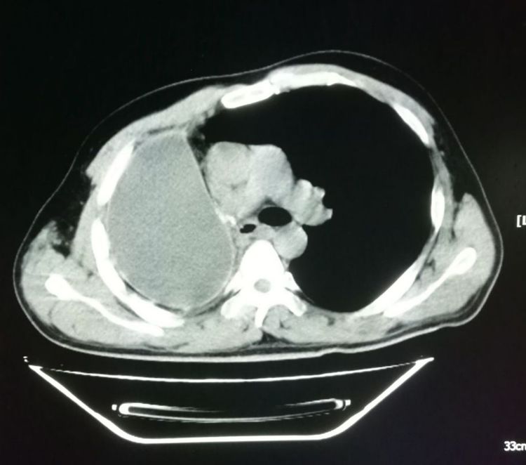 肺癌手术后胸腔内有碎肉怎么办,肺癌切除手术后有个空腔