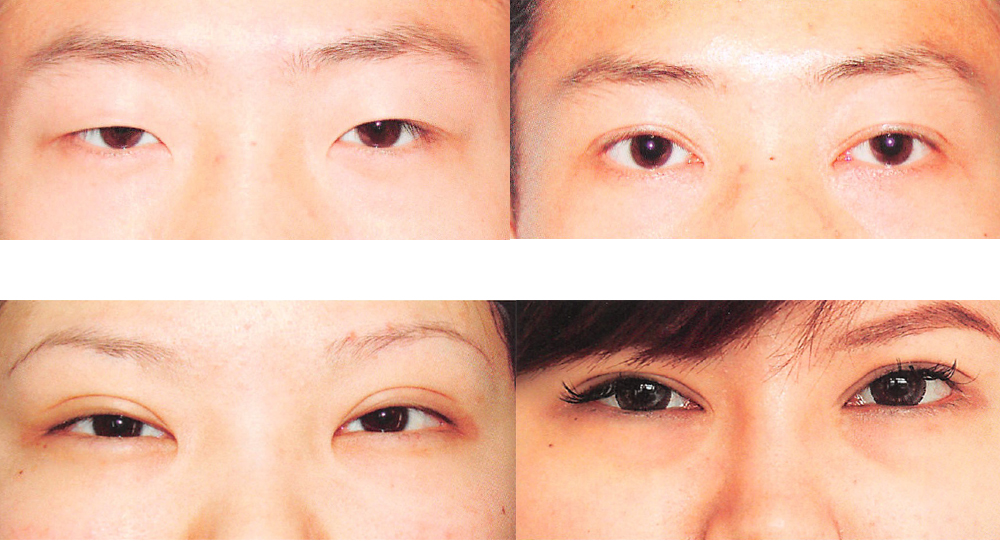 内眦赘皮要去整形医院吗,内眦赘皮怎么整形