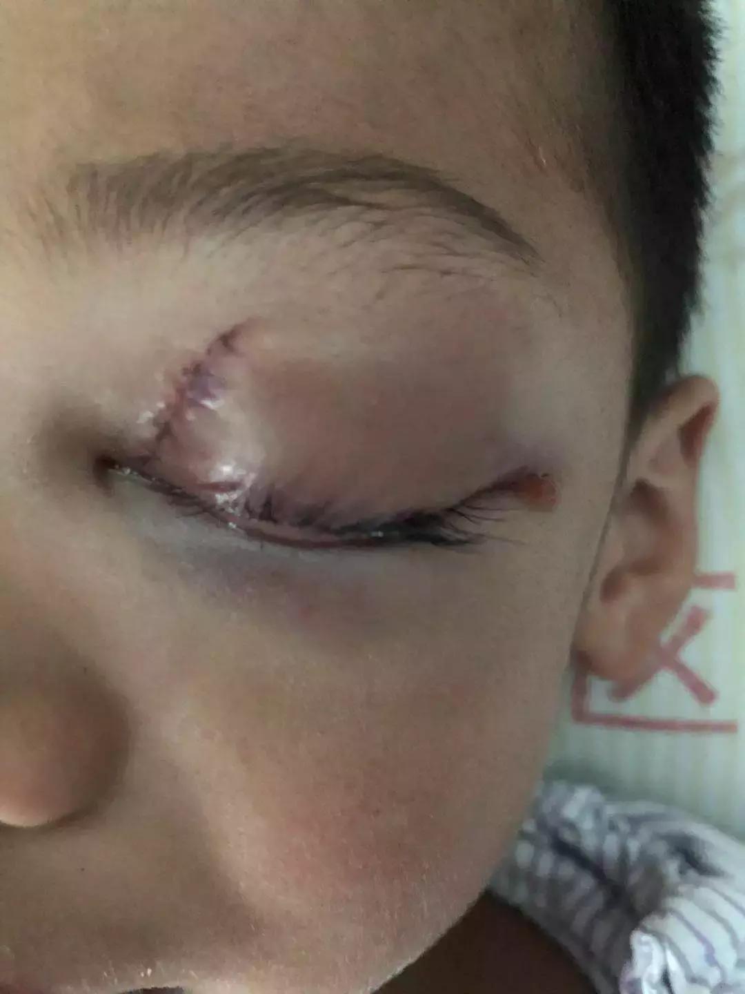 小孩不小心摔跤眼睛受损,四岁孩子摔破眼睛边