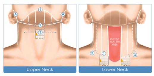 做完超声刀要忌口多久,超声刀做完后有哪些后遗症