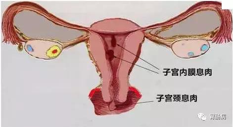 肠息肉切除还是不切除,肠息肉和胆囊息肉必须做手术吗