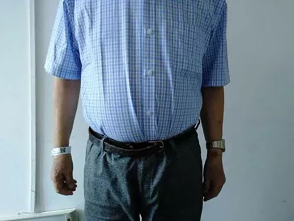 老人听信偏方乱投医吃错了药,大伯吃掉上百支皮炎平软膏