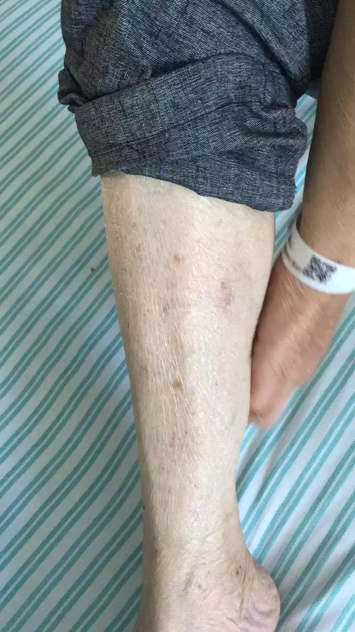 天呐！大伯吃掉上百支治皮炎的软膏，医生一问都懵了