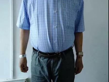 天呐！大爷3年吃掉100多支“皮炎平”软膏！医生一问原因都懵了