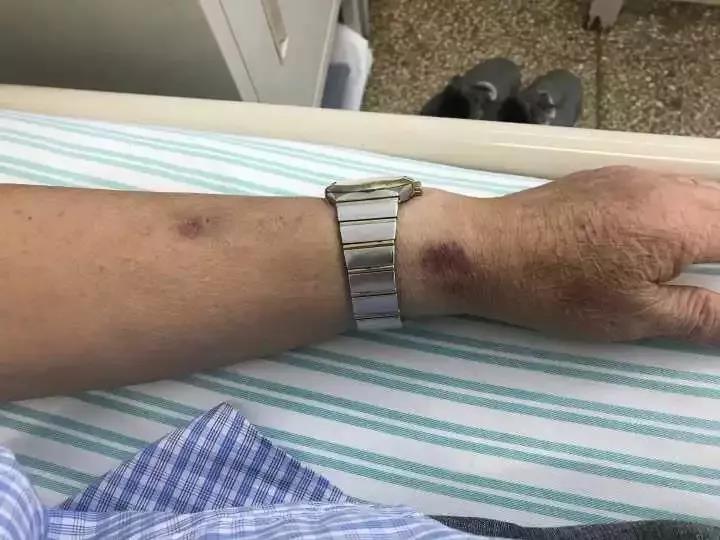 天呐！大爷3年吃掉100多支“皮炎平”软膏！医生一问原因都懵了